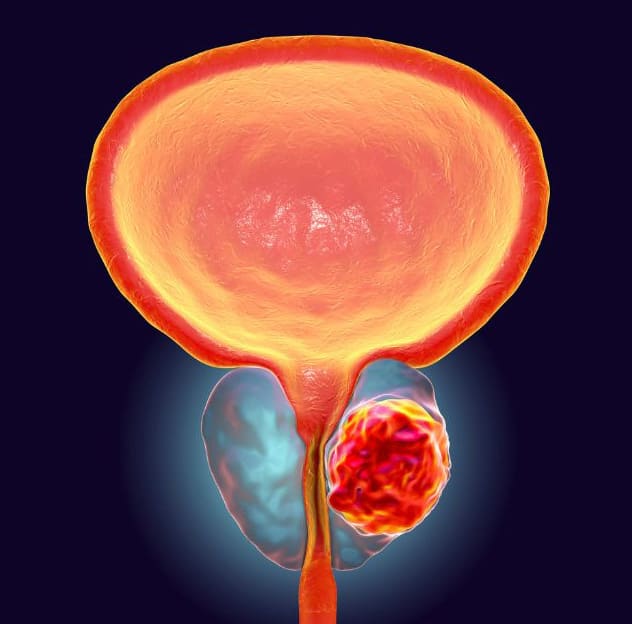 illustration of a cancerous tumor in the prostate gland