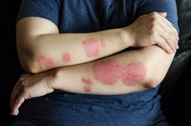 Skin Lesions on the Elbows