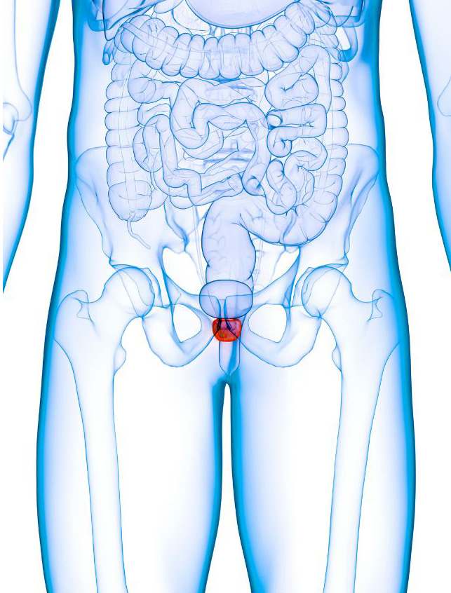 Illustration of Inflamed Prostate