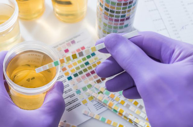 photo of urine test strips