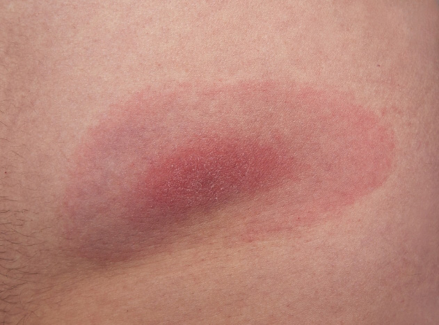 Lyme borreliosis from a tick bite