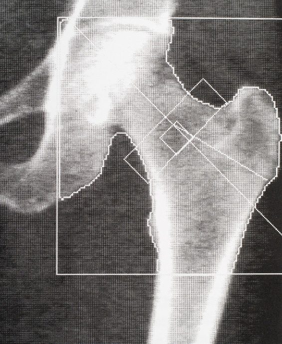 Bone density medical scan - hip. Osteoporosis diagnosis.