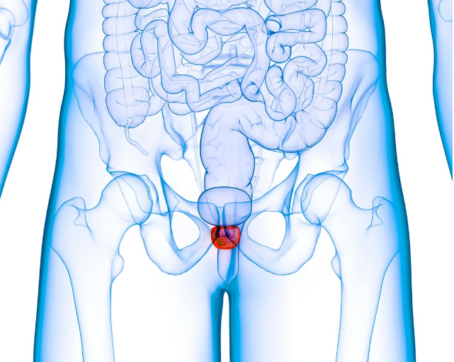 illustration of Inflamed prostate