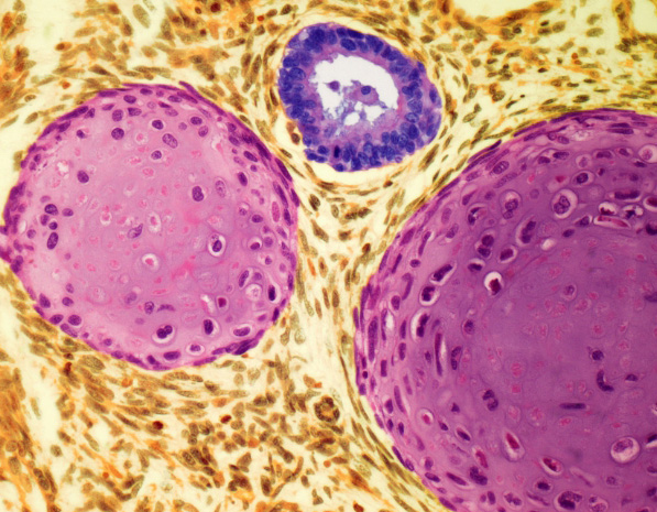Testicular cancer - Light micrograph of a section through a teratoma of the testis
